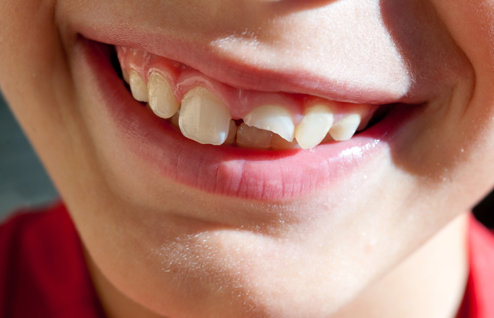 Quebrar os dentes da frente: o que fazer nessa situação? 2 Dente quebrado 2