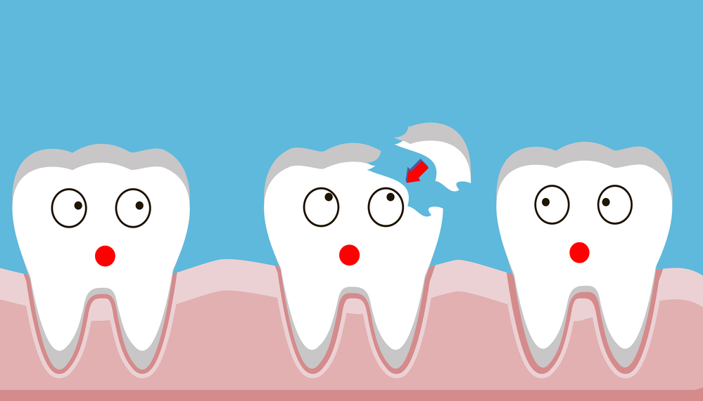 Quebrar os dentes da frente: o que fazer nessa situação? 3 Dente quebrado 3
