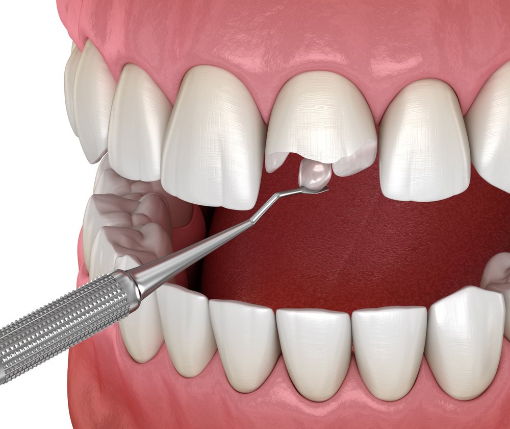 Quebrar os dentes da frente: o que fazer nessa situação? 4 Dente quebrado