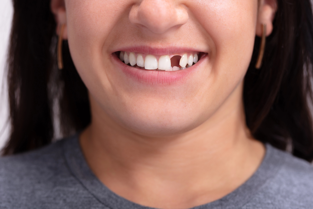 Quebrar os dentes da frente: o que fazer nessa situação? 1 Quebrar os dentes da frente