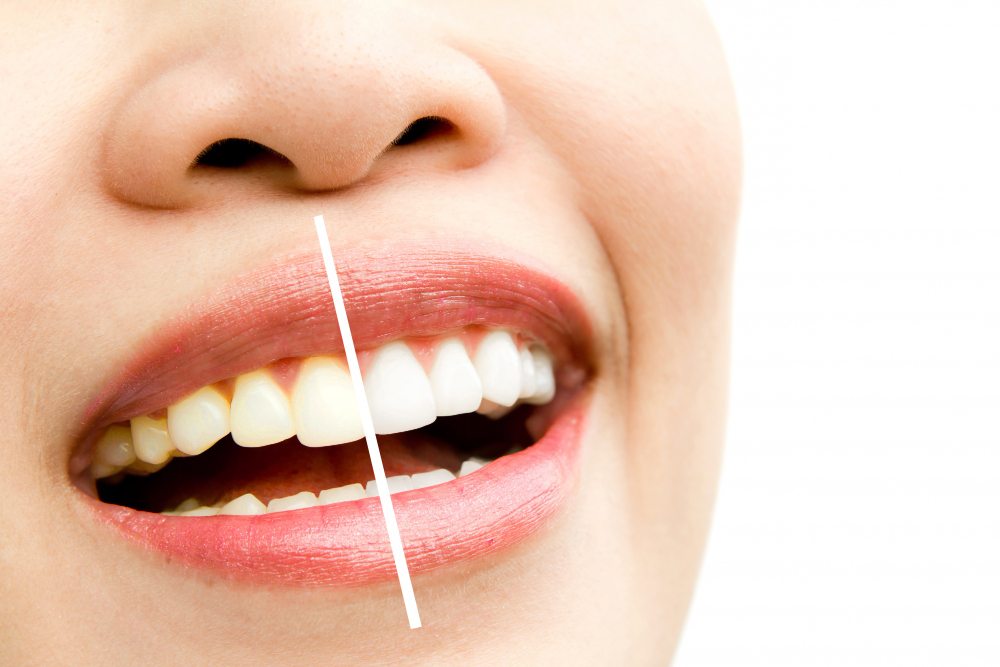 Como funciona o clareamento dental? 2 clareamento dental 2